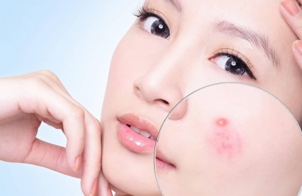 Hướng dẫn cách đắp mặt nạ trà xanh cho da nhờn mụn hiệu quả tại nhà